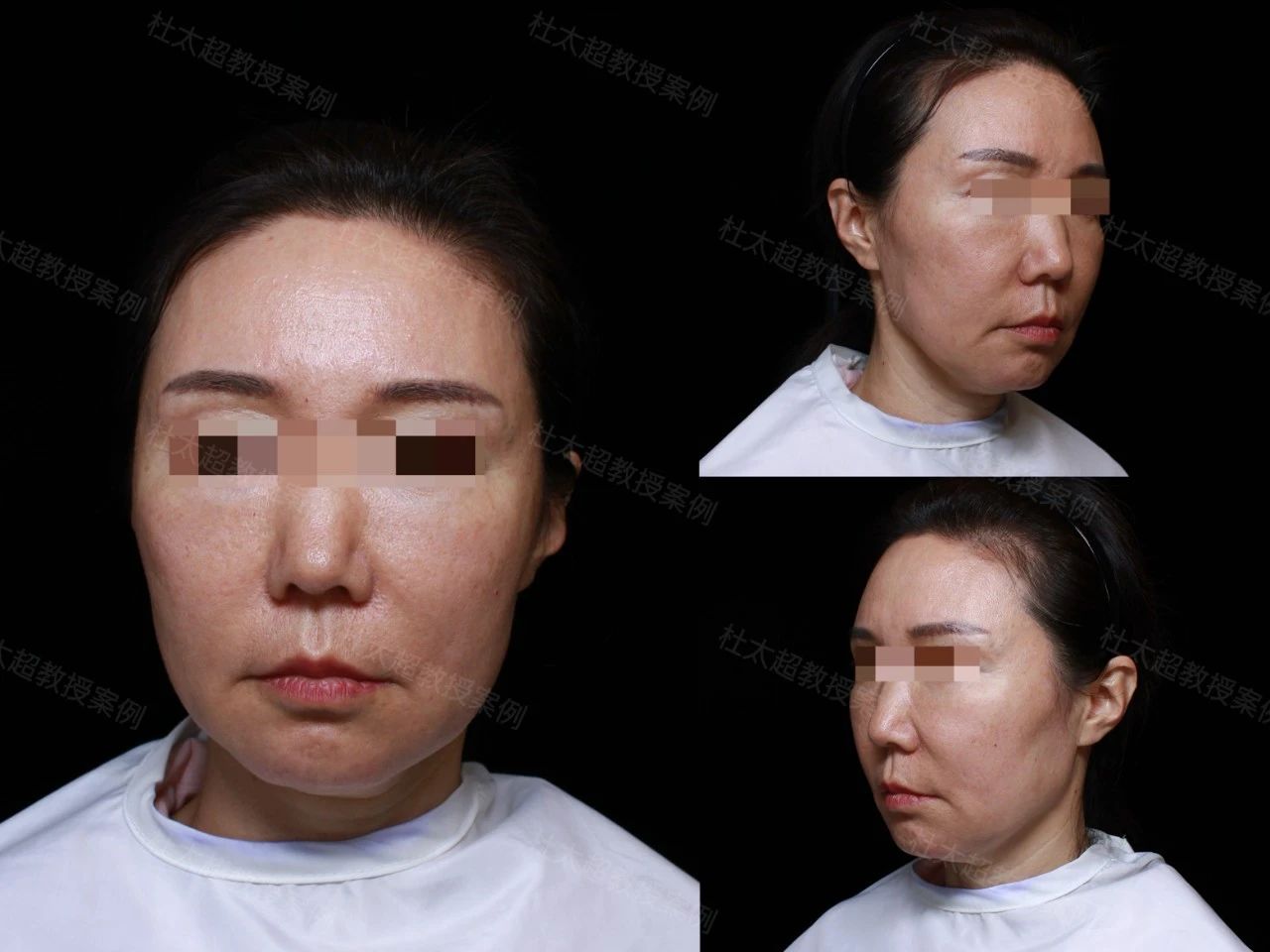 整容还是自然老去？49岁的她为何选择拉皮手术！