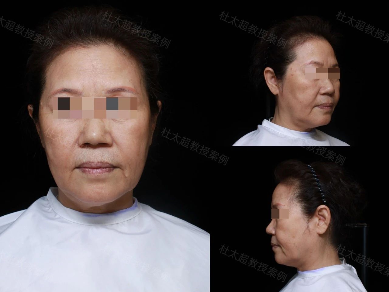 60岁求美者caw小切口面部提升缩紧术后深度分析