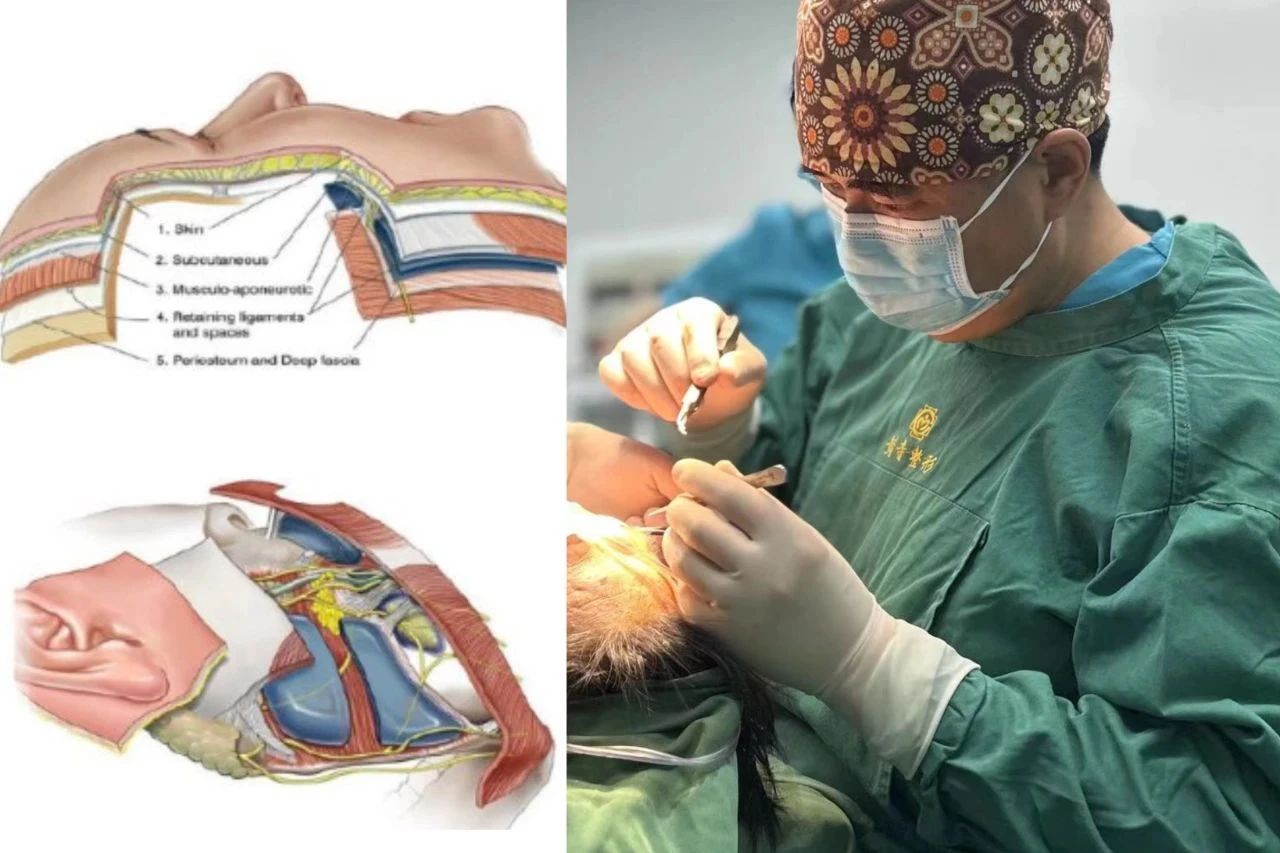 60岁求美者caw小切口面部提升缩紧术后深度分析