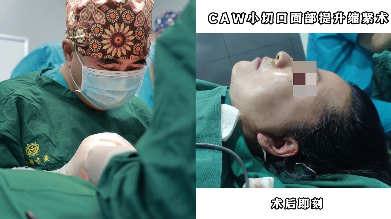 揭秘！拉皮手术：美丽背后的十大惊人真相，你还敢做吗？