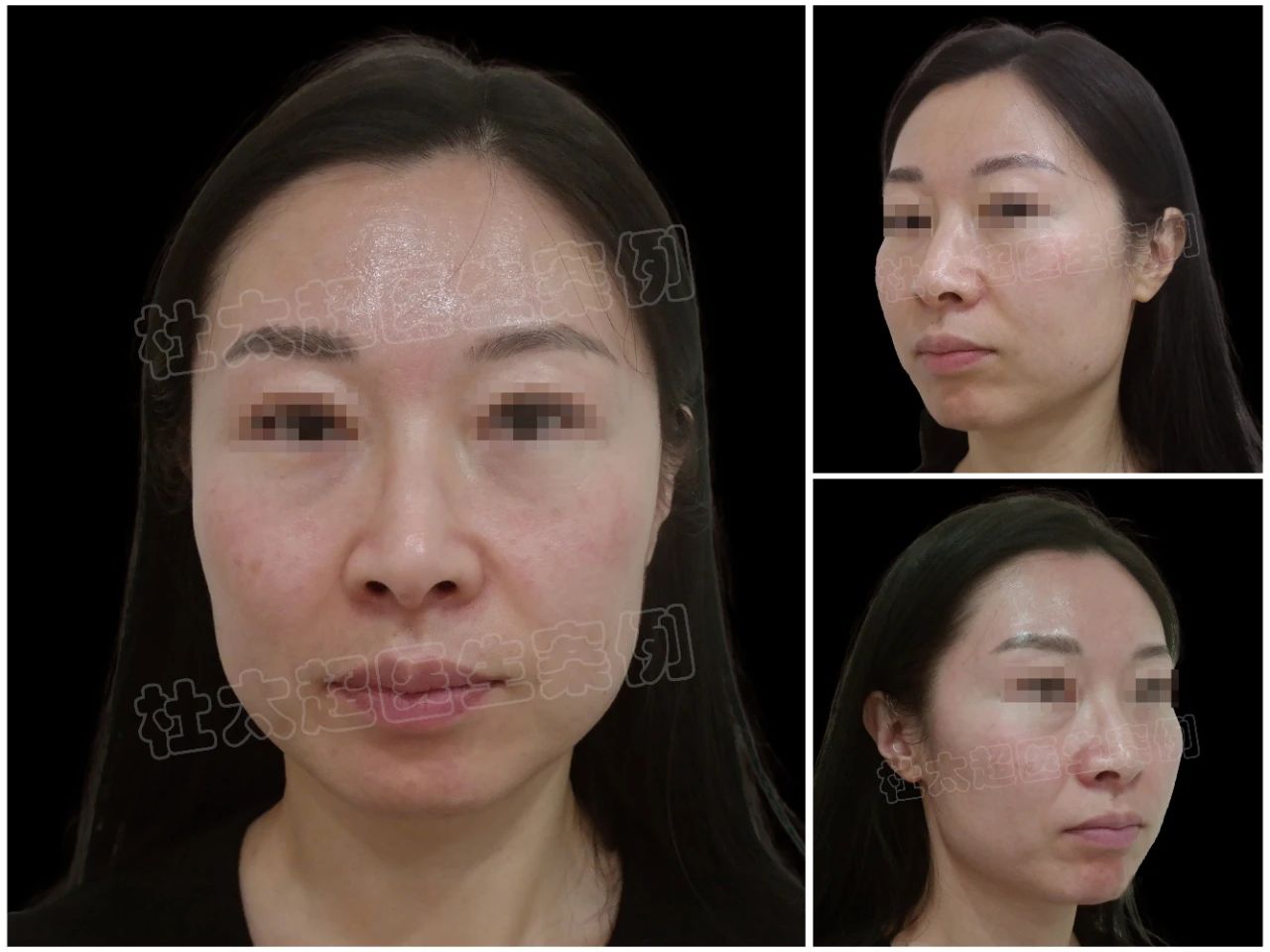 时光见证的美丽奇迹：40+女士caw小切口面部提升缩紧术后8年的深度剖析