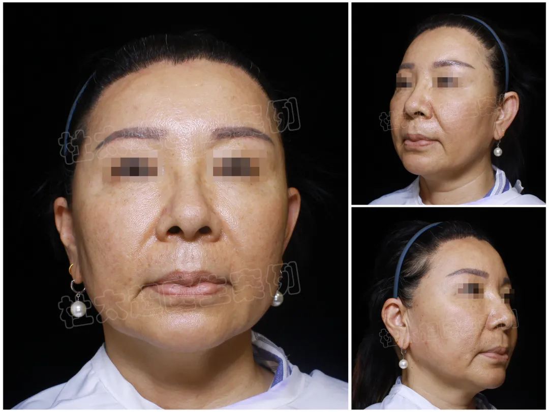 拉皮手术这事儿，到底是骗人的还是真敢干？你怎么看？