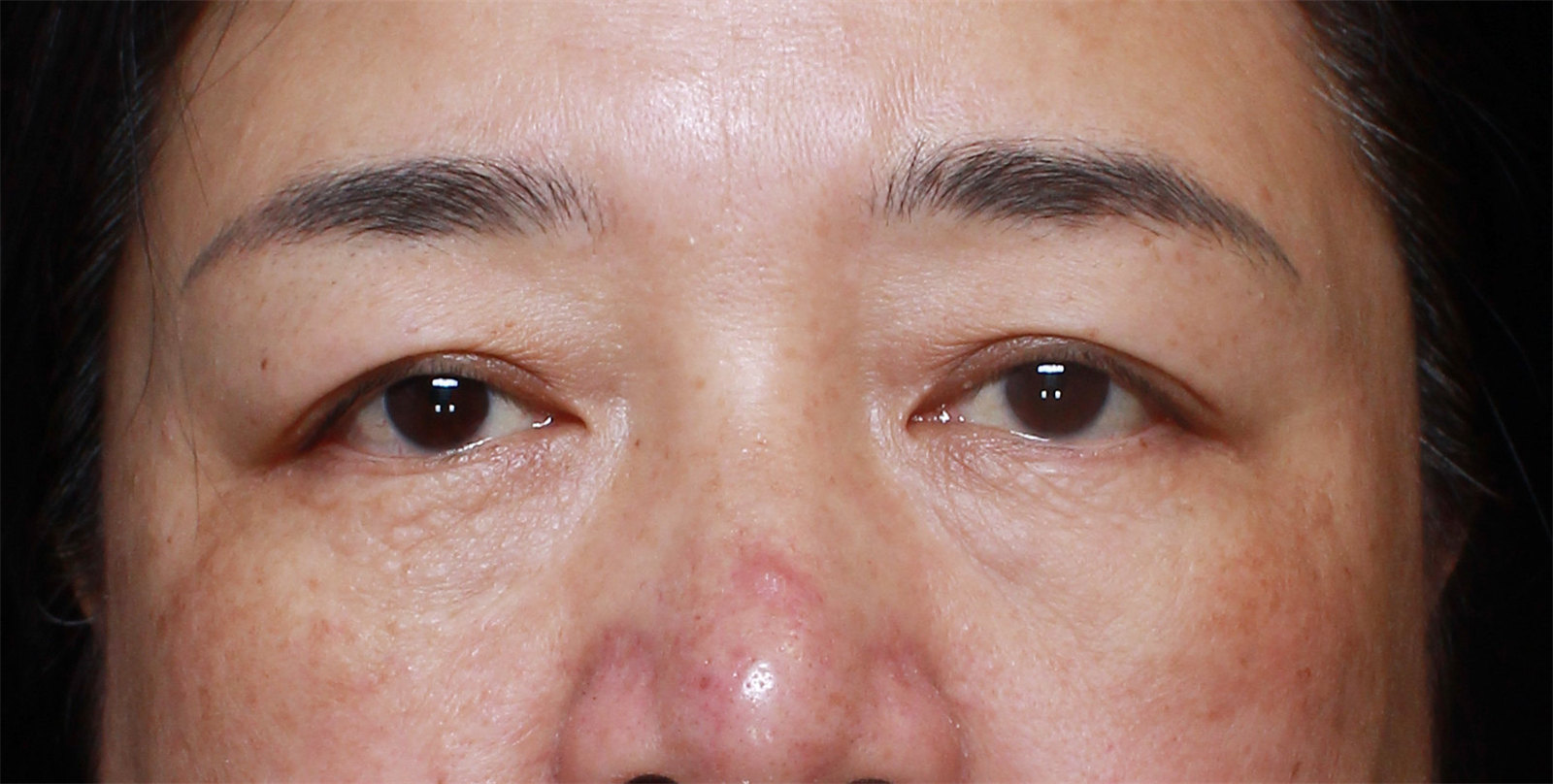 47岁大姐挑战眼周年轻化，术后40天，年轻了好多！