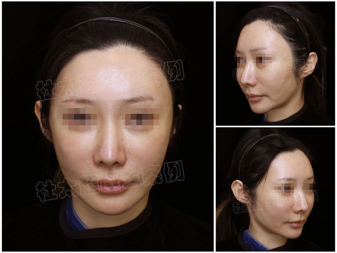 40岁大姐真心话：做拉皮手术，是真年轻了还是瞎折腾？