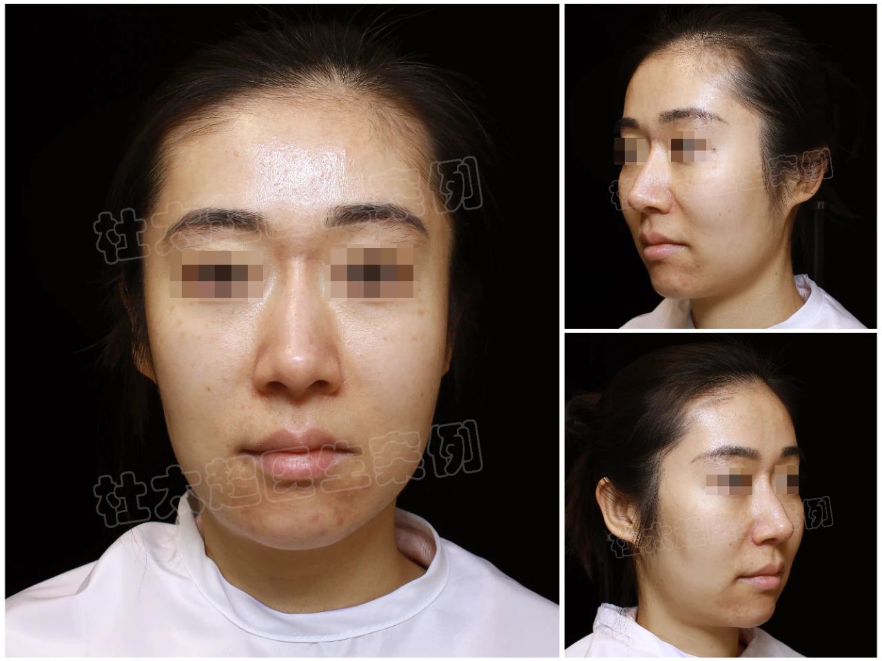 33岁女士caw小切口面部提升术后6个月深度分析