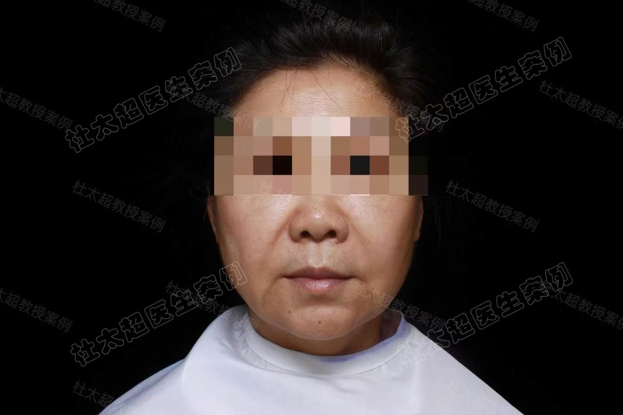 60岁深陷线雕漩涡，终于因为一次拉皮手术上岸