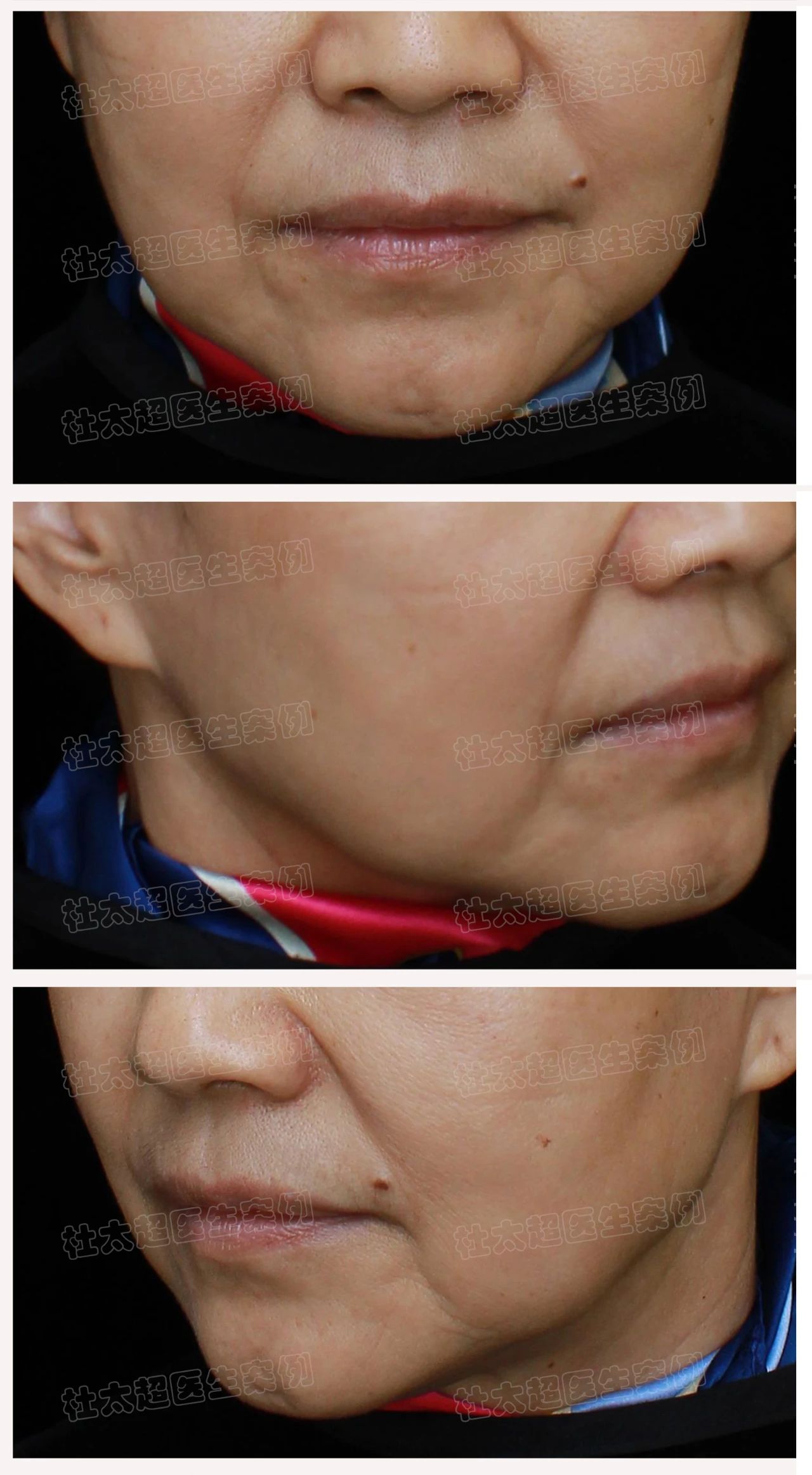 60岁求美者拉皮手术提升中下面部术后4个月深度分析