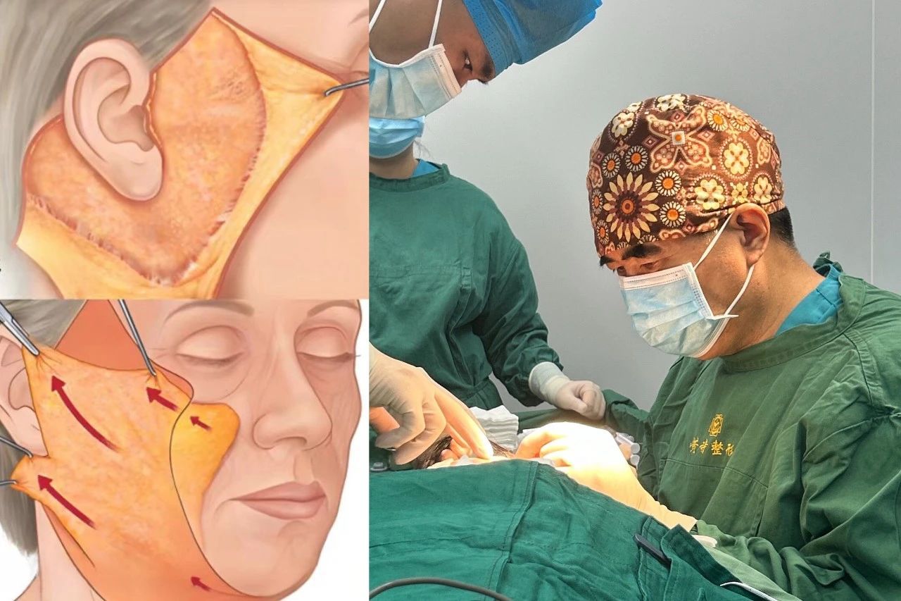 60岁求美者拉皮手术提升中下面部术后4个月深度分析