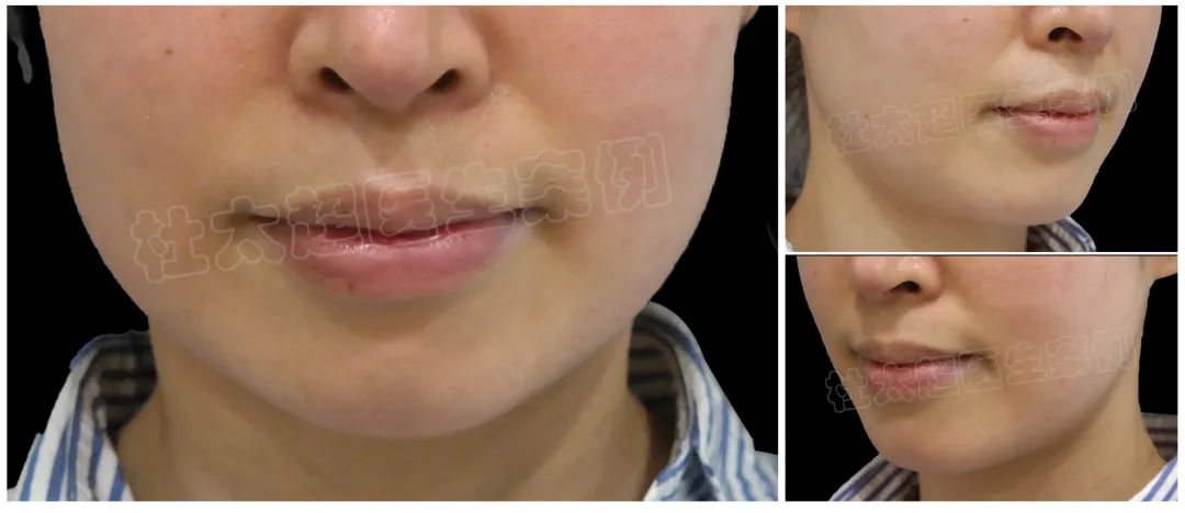 一刀下去,年轻十岁?44岁女士拉皮术后三年,年轻得不像话! 一刀下去,年轻十岁?44岁女士拉皮术后三年,年轻得不像话!