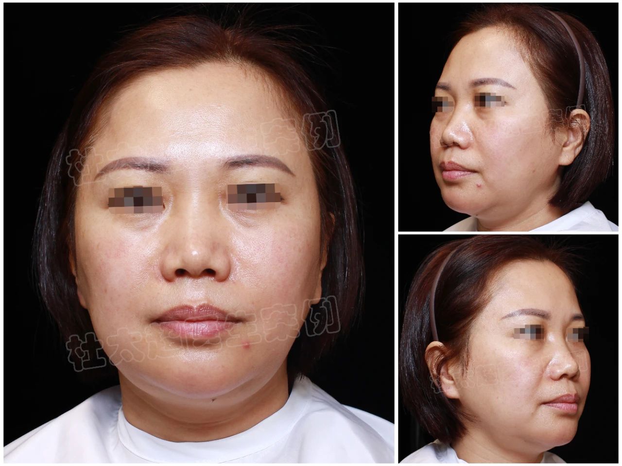 争议之下，我为何选择拉皮手术？它让我找到了更美的自己——整容后的心声