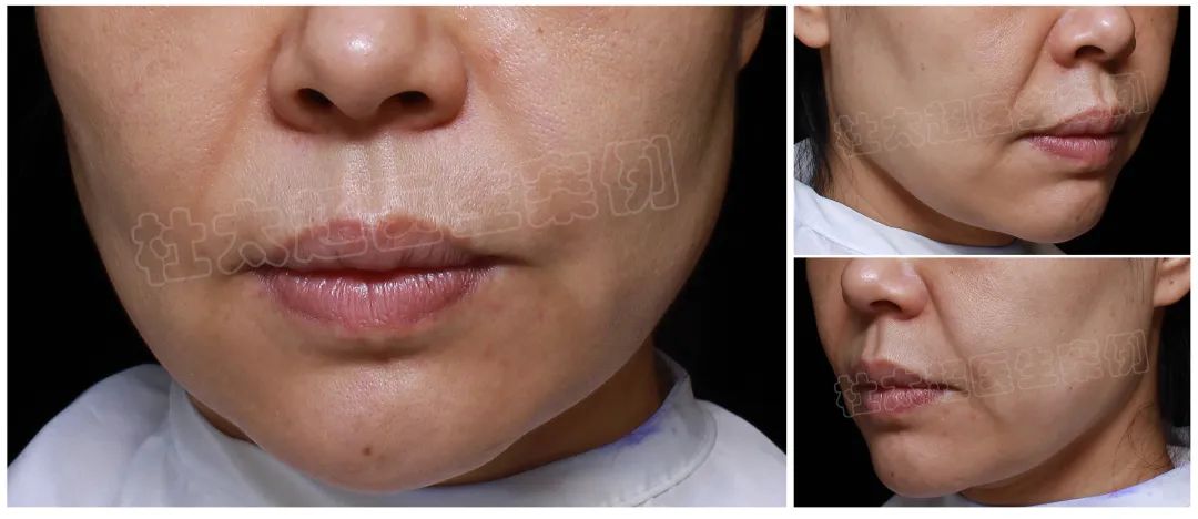 42岁求美者术后7天，拉皮手术是否过度追求年轻？