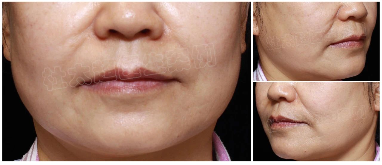 56岁求美者caw小切口面部提升缩紧术术后一年深度分析