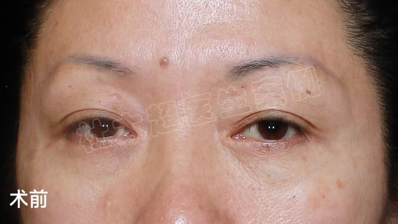 做完眼周年轻化术后1个月，忍不住分享手术心得 以下为求美者自述： 做眼周年轻化手术这件事，我想了很久，考虑了手术的利弊，最终还是决定搏一搏。  面诊时医生说我上下眼睑都存在衰老问题： 1、眼皮松弛明显，上眼睑皮肤松弛，睁眼无神。 2、下眼睑脂肪膨出 所以，医生综合我的基础帮我设计了手术方案：切眉手术+外切去眼袋。术后效果我很满意，所以想把我的手术心得分享给大家。  1、术前做好心理准备 术前了解的越多，手术时心里越有底，手术过程也就越放松。  2、不必纠结恢复期 任何手术都有恢复期，既然决定了要做手术改变，就不要再去纠结恢复期，保持好心情和良好的作息，基本上一天一个变化，一般7天拆线就已经消肿80%了，出门见人没有问题，之后就是切口痕迹逐渐淡化的问题了。 3、不要在意别人的眼光 别人的评价是暂时的，只有自己的成就是终身的。再说，现在手术年轻化很普遍，在群众中的接受度也非常高，所以，基本上身边很少有异样的眼光，相反，大家看到我的术后效果这么棒，都跃跃欲试，想要自己也改变一下。 所以，想做眼周年轻化手术就做吧，取悦自己有何不可呢？