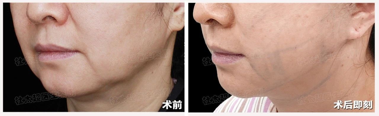 50岁求美者拉皮手术术后一年深度分析