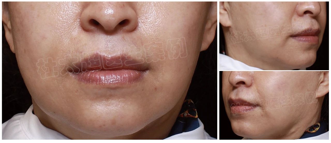 55岁求美者拉皮手术术后50天深度分析