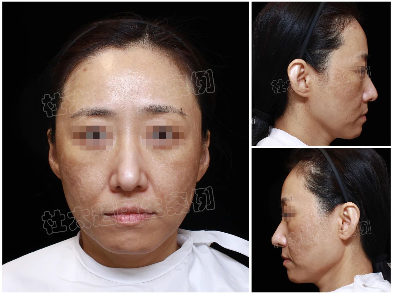 44岁拉皮手术后8个月，是否真正“逆龄”？术后效果引发热议！