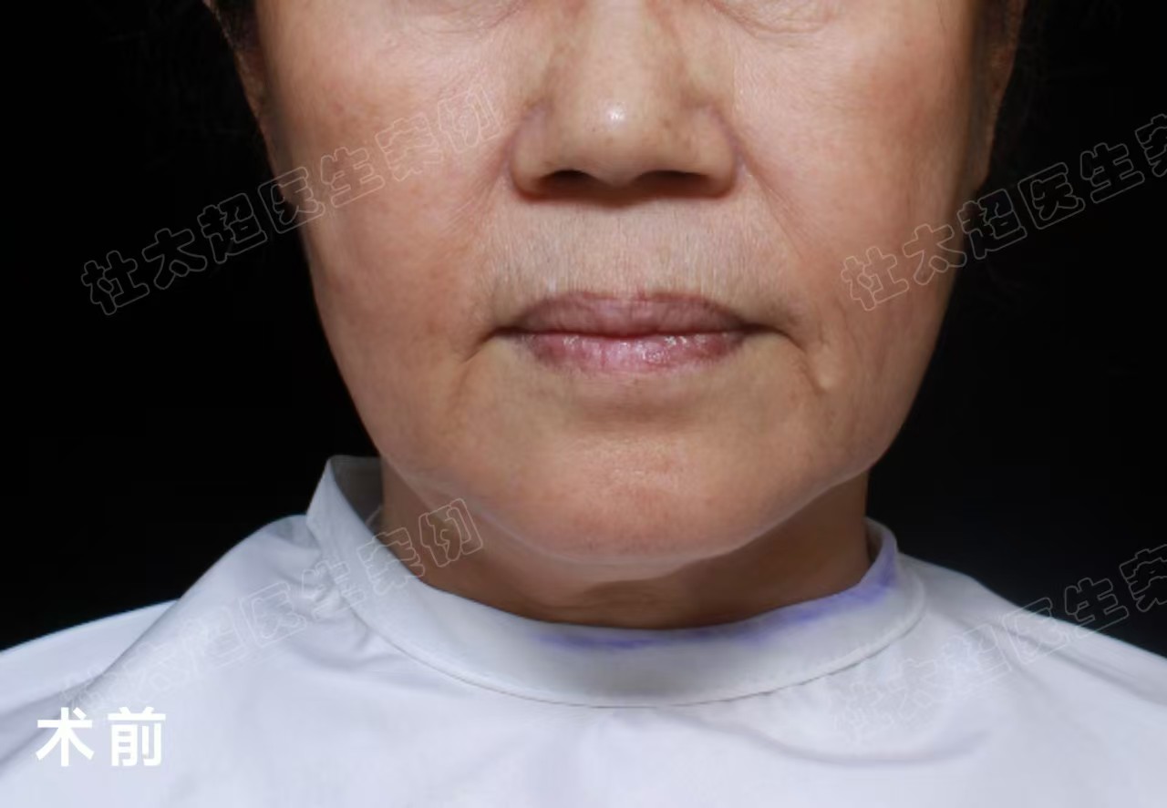 60岁姐姐挑战拉皮手术，术后3个月变得大不一样