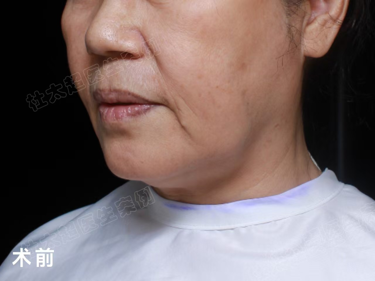 60岁姐姐挑战拉皮手术，术后3个月变得大不一样