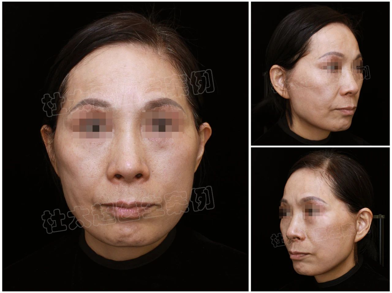 57岁做完拉皮手术一年半，算是看明白了... ...