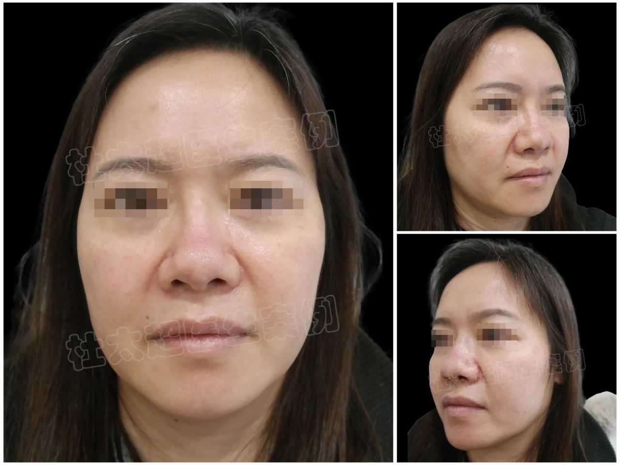 何时做拉皮手术最好？听听一个50岁女人的心声！