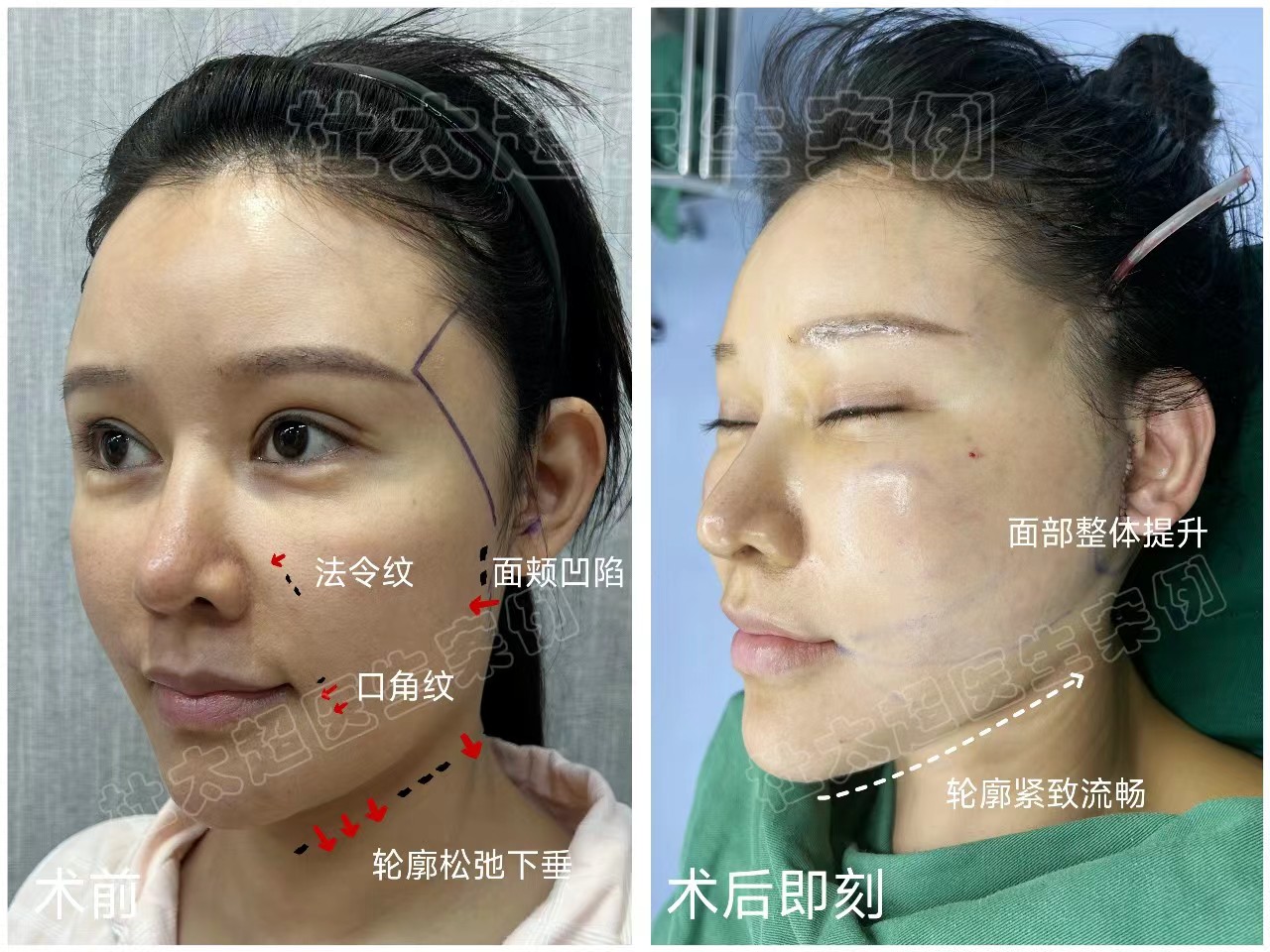 38岁女士追求美丽与青春，术后很惊艳，分享她的治疗方案