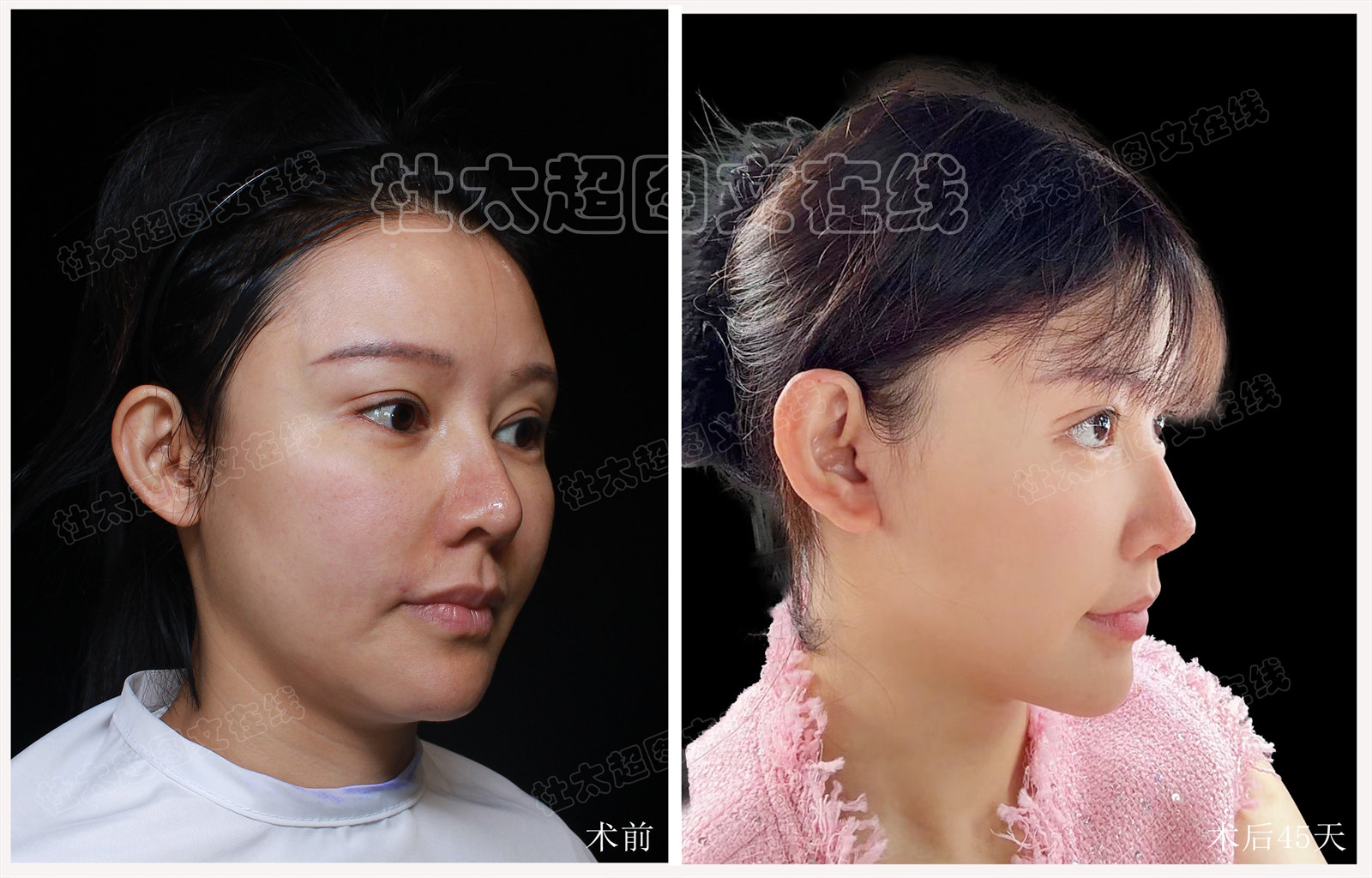 38岁女士追求美丽与青春，术后很惊艳，分享她的治疗方案