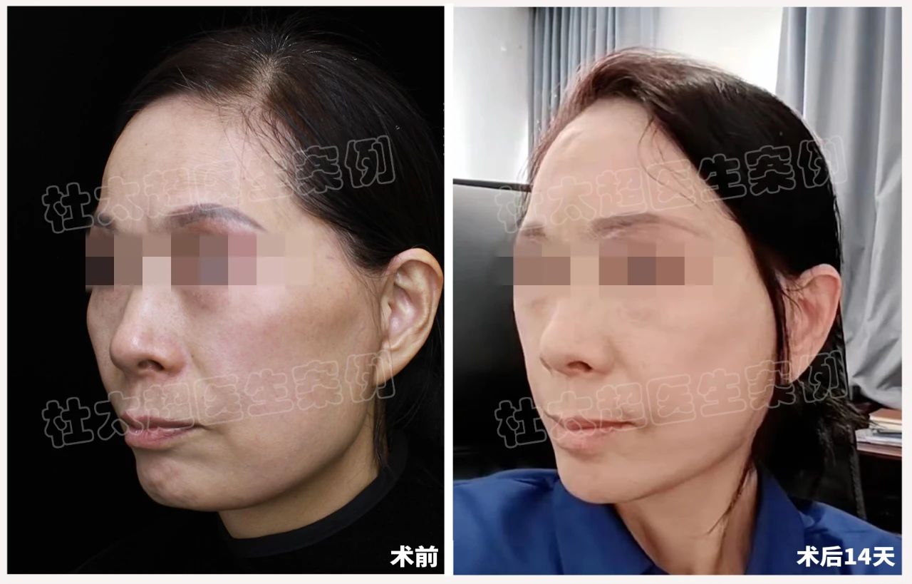 钱重要还是脸重要？57岁女士拉皮手术失败的血泪史！赶紧来看看吧...