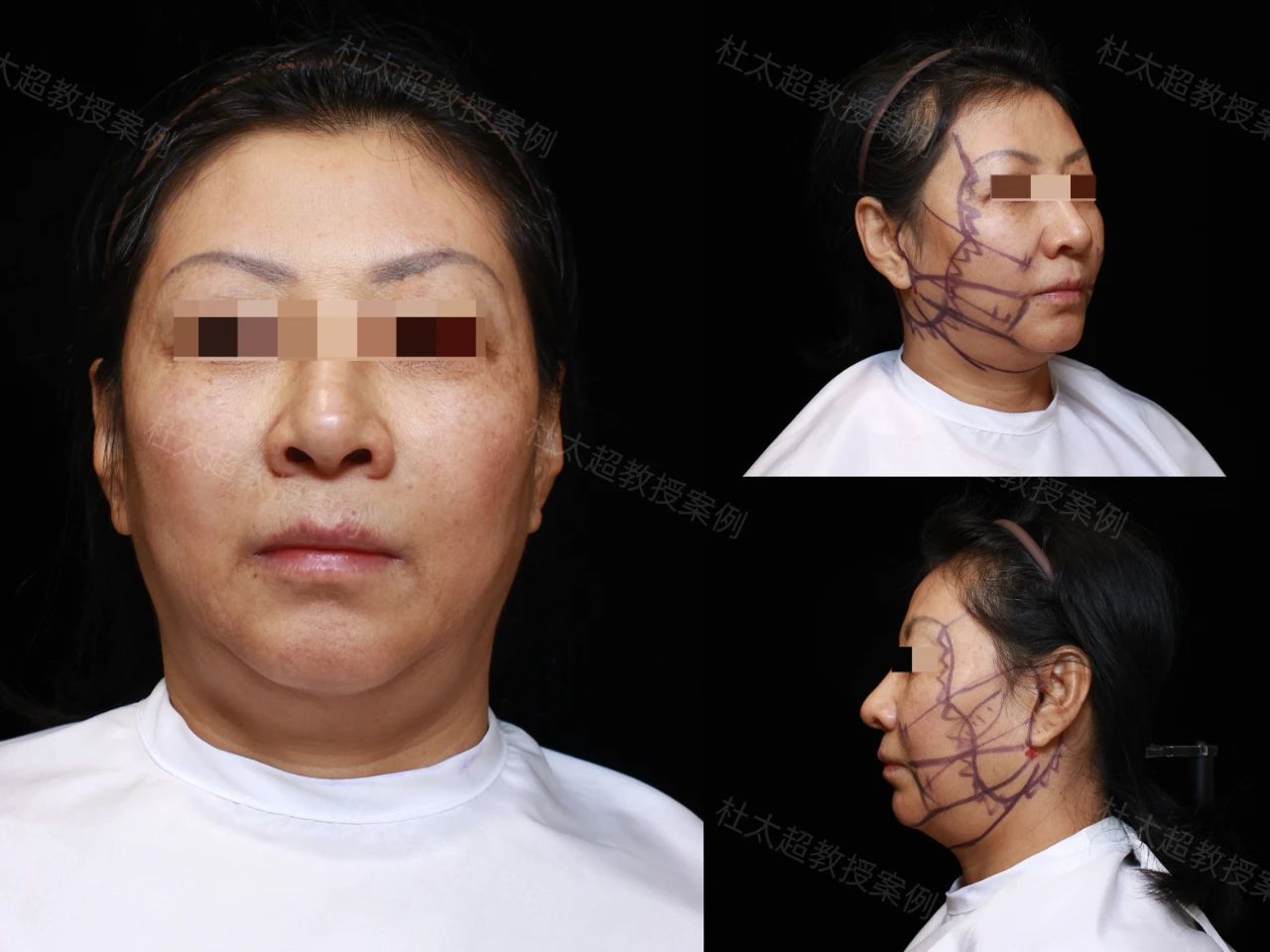 57岁大姐挑战拉皮手术，术后1个月 、3个月对比深度解析，这也是您所期待的样子吗?