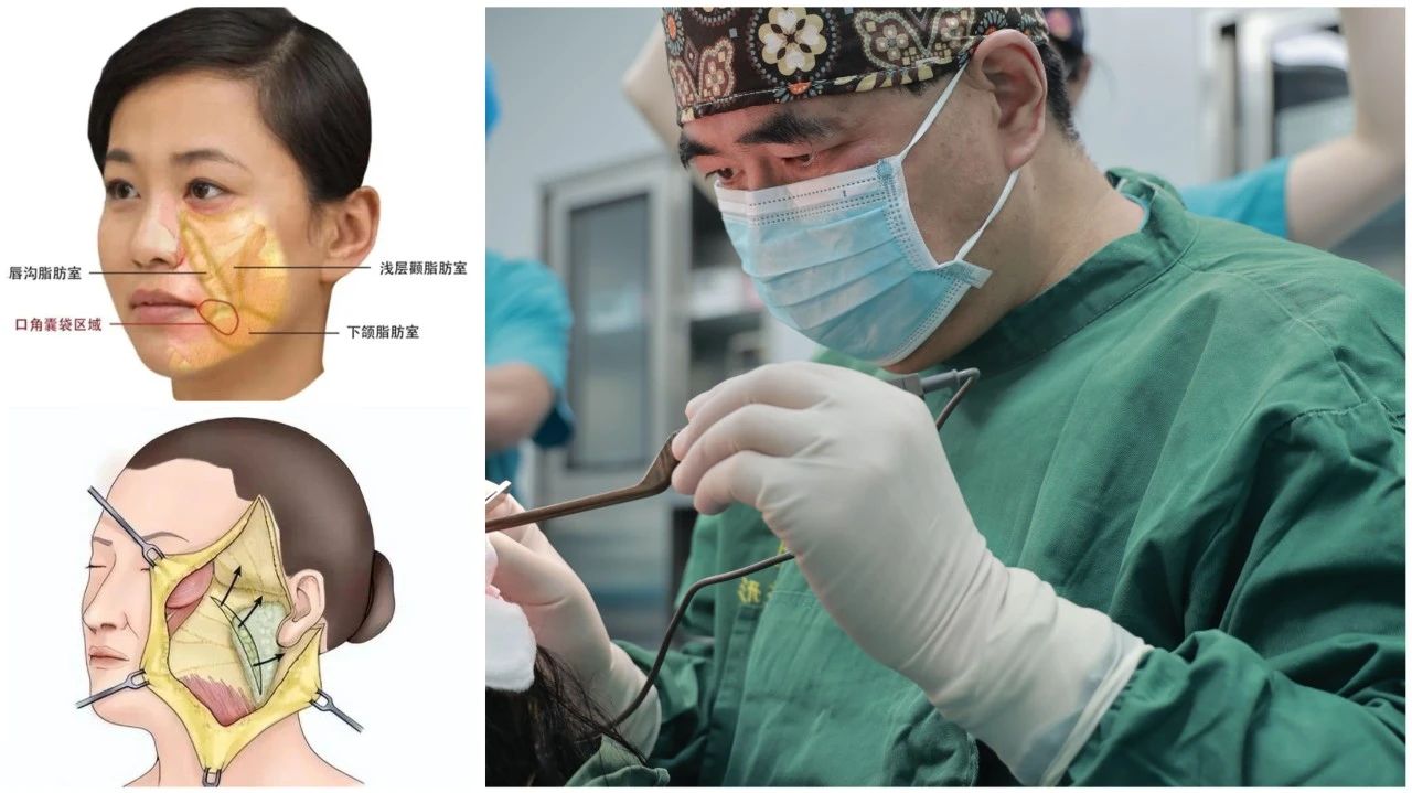 十年青春不掉线！揭秘caw小切口面部提升缩紧术的抗衰秘籍