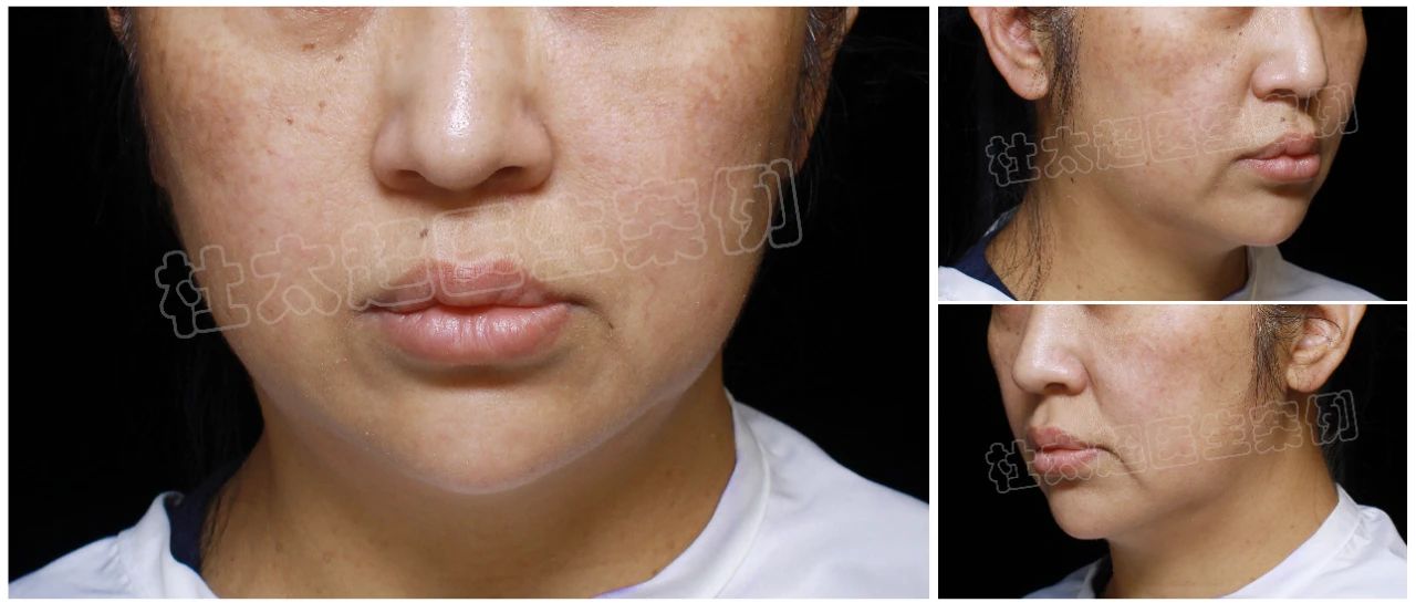 54岁揭秘高端拉皮术，费用虽高但效果让人难以置信！