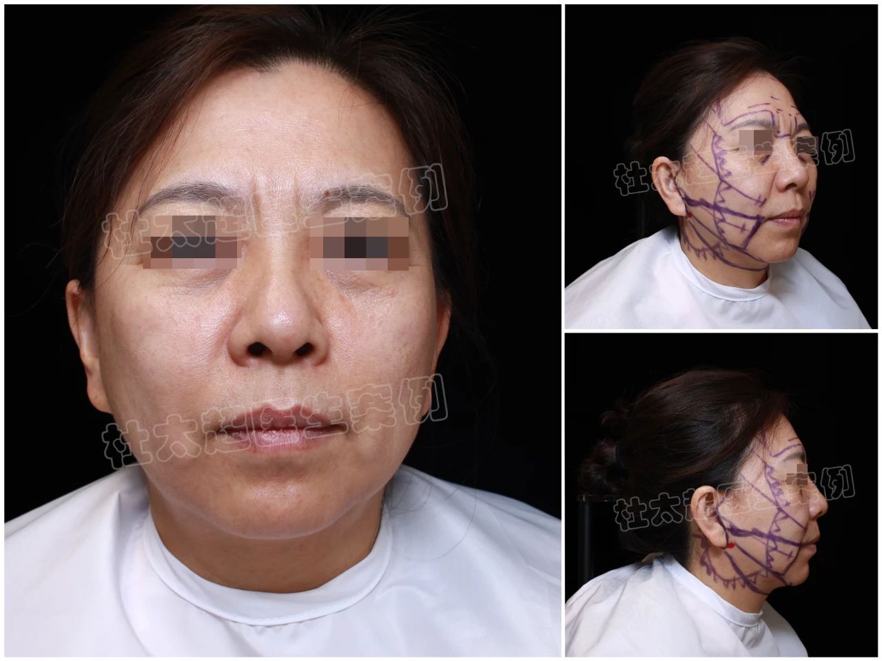 54岁女儿勇敢尝试拉皮手术，70岁老妈全力护航！术后效果究竟有多震撼？