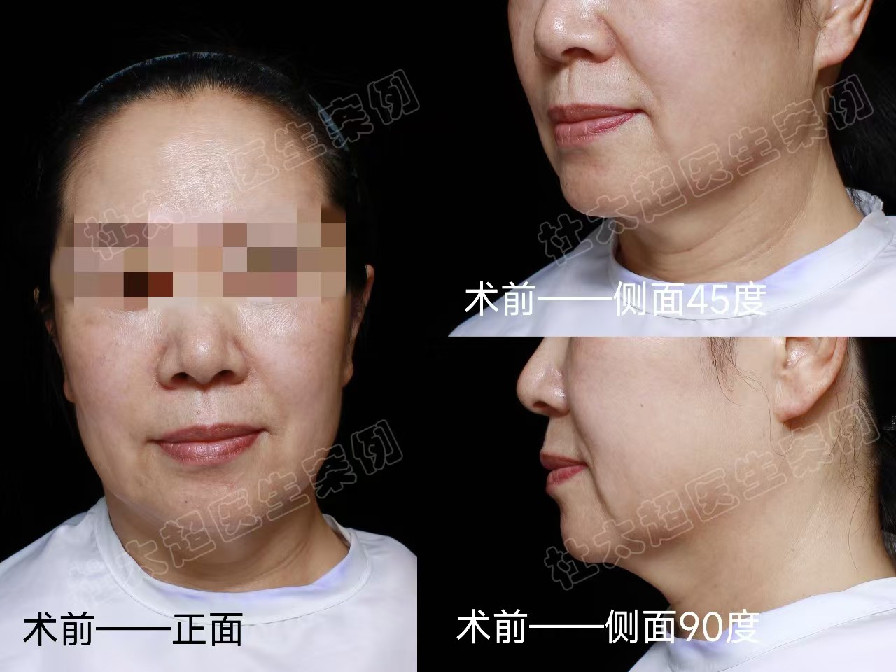 62岁忍不了“松垮垂”，决定做拉皮手术，术后即刻效果很惊艳！