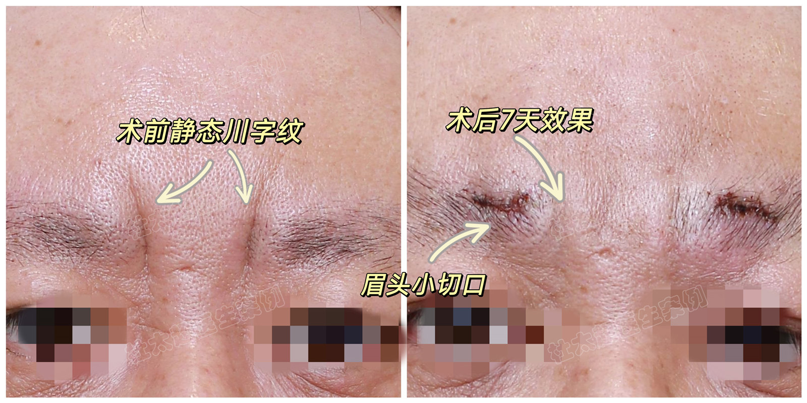 为什么有些人的川字纹，就像烙上去的？