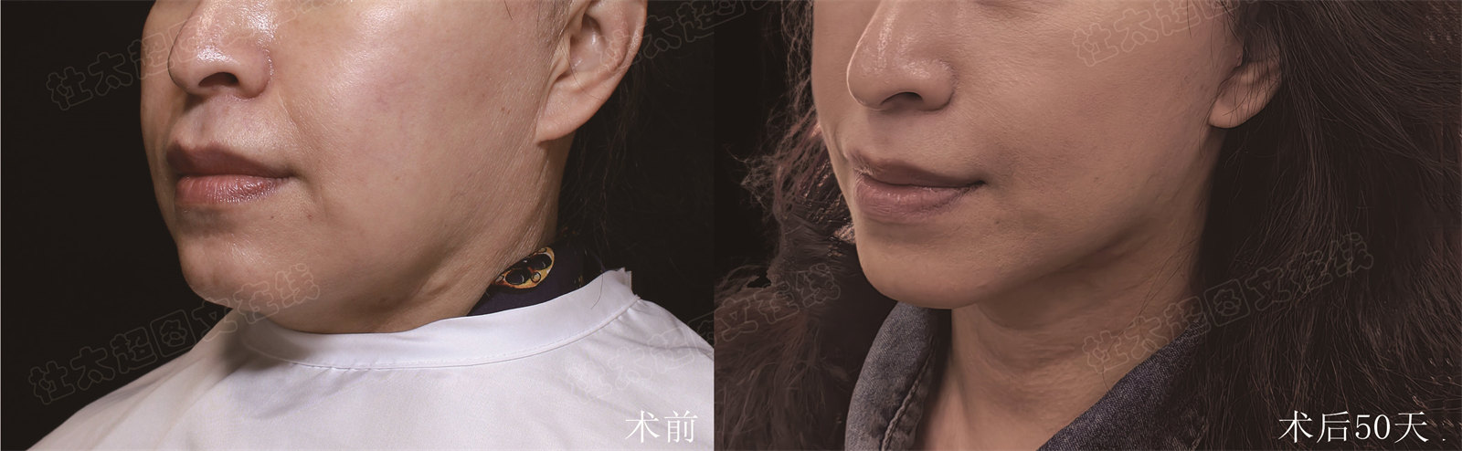 不接受自己变老，又抵制医美，这不自己遭罪吗？