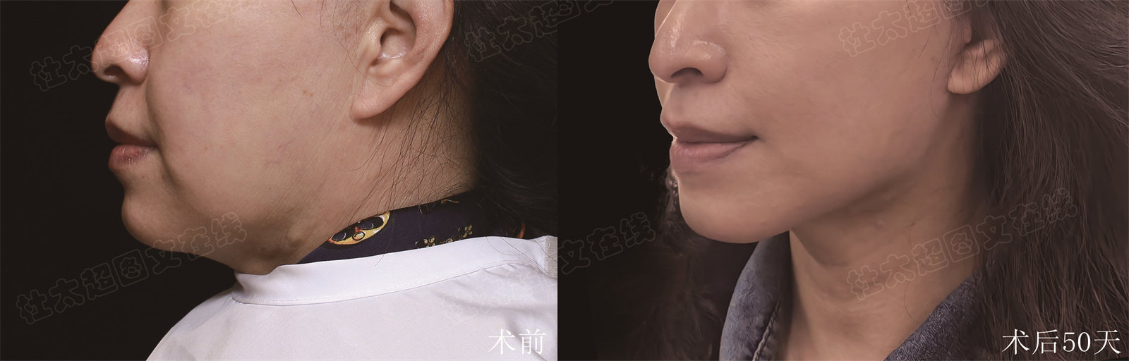 不接受自己变老，又抵制医美，这不自己遭罪吗？