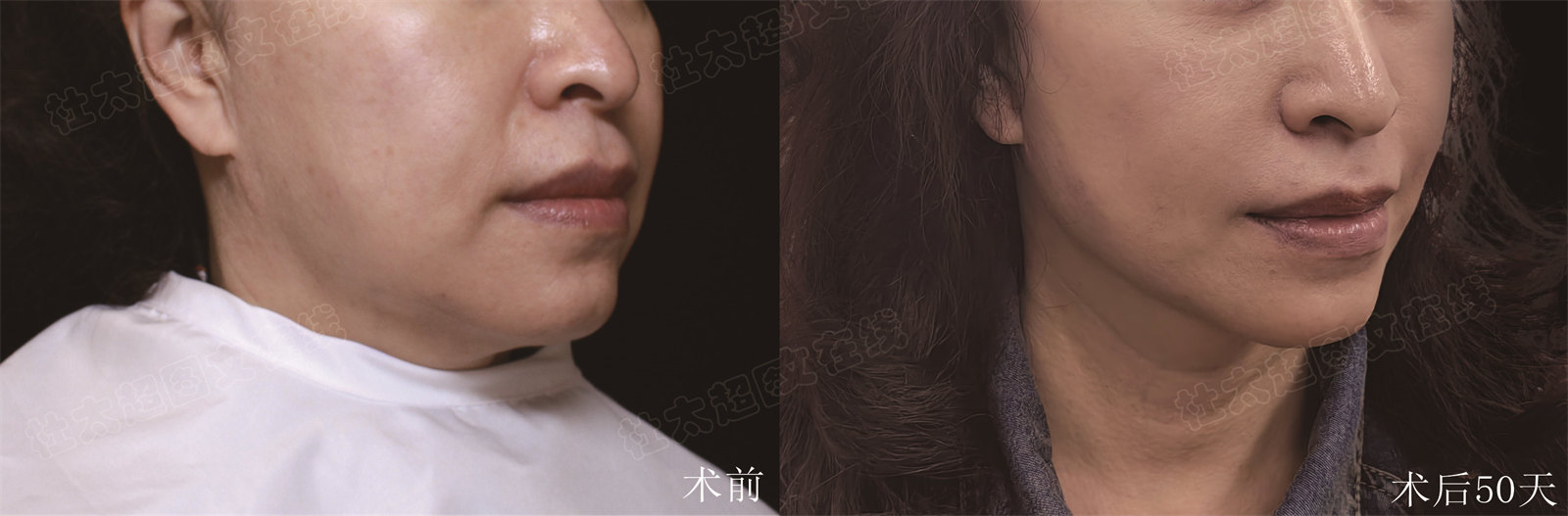 不接受自己变老，又抵制医美，这不自己遭罪吗？