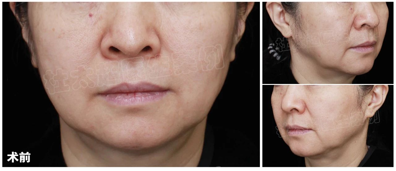 这个50岁女人把自己宠上了天,拉皮手术非做不可!效果尽然如此让人惊叹~ 这个50岁女人把自己宠上了天,拉皮手术非做不可!效果尽然如此让人惊叹~