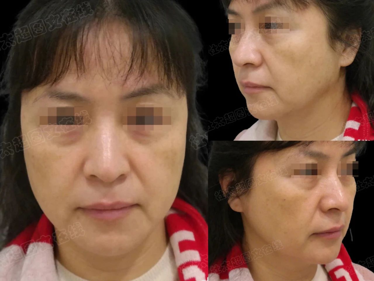 54岁求美者caw小切口拉皮手术：即刻、2个月及四年惊艳效果展示