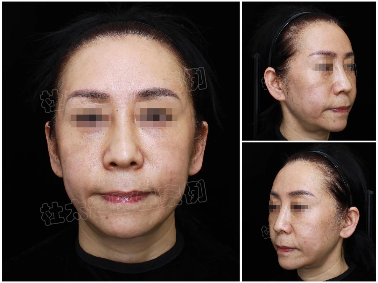 caw小切口面部提升术真有那么神？看这位54岁求美者如何重返青春！