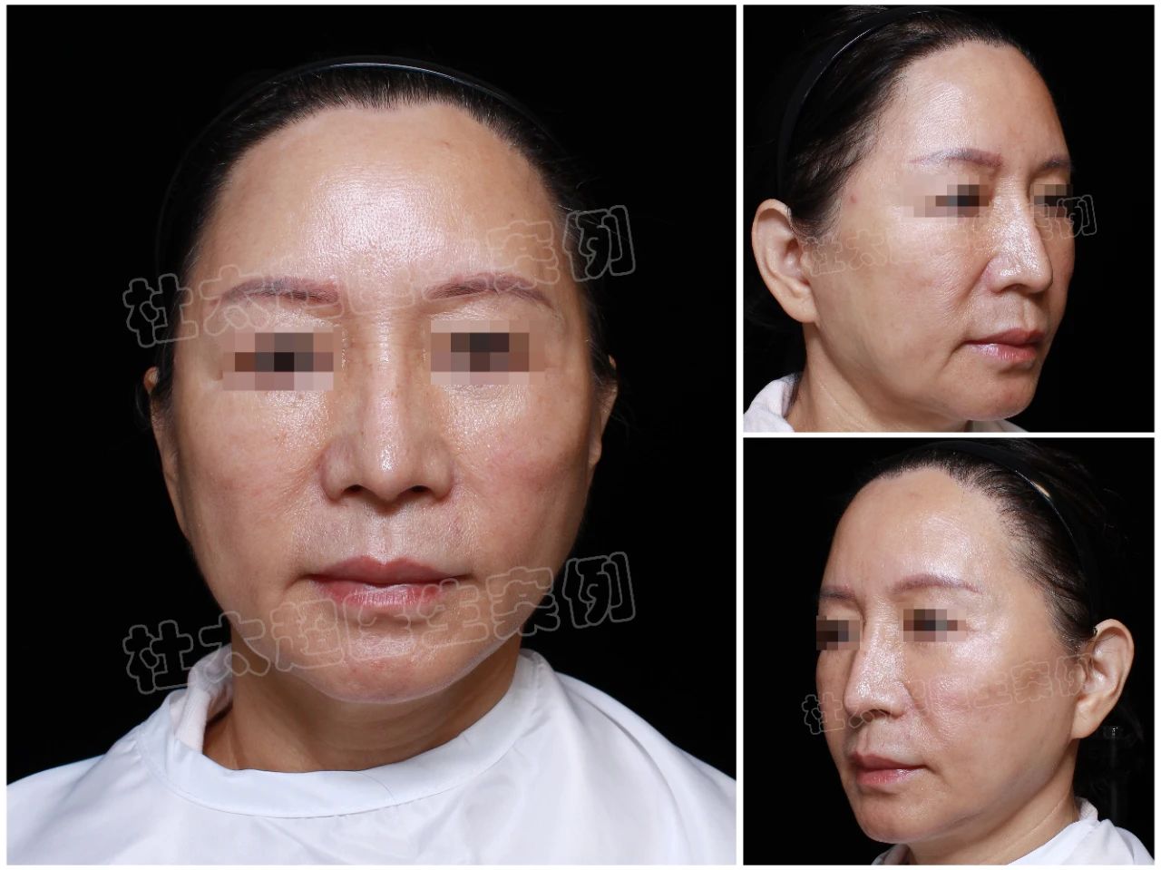 61岁还能 折腾?！不远万里从“美丽”国飞回来做拉皮手术，这样的效果是她没有想到的！