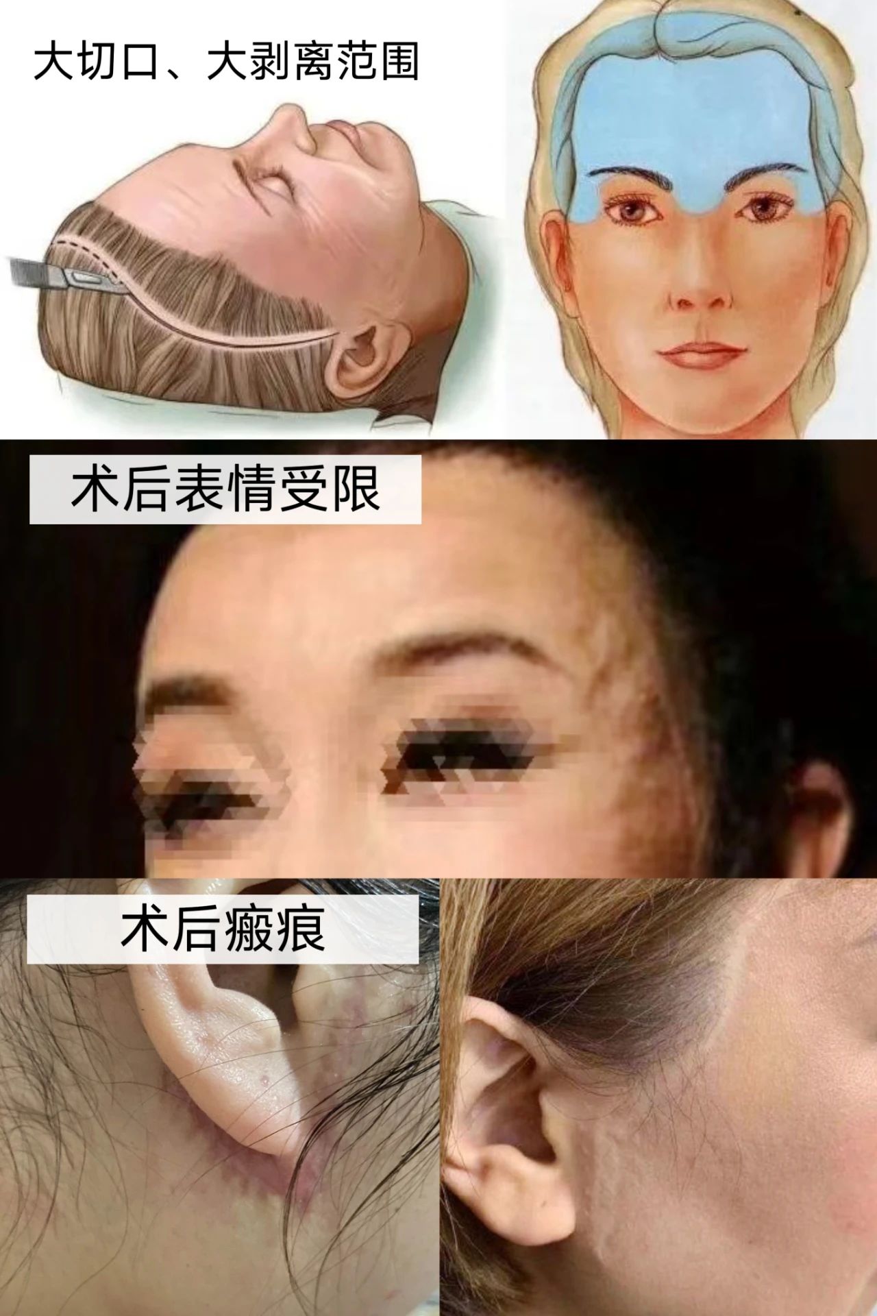 拉皮手术剥离范围越大效果就越好吗？