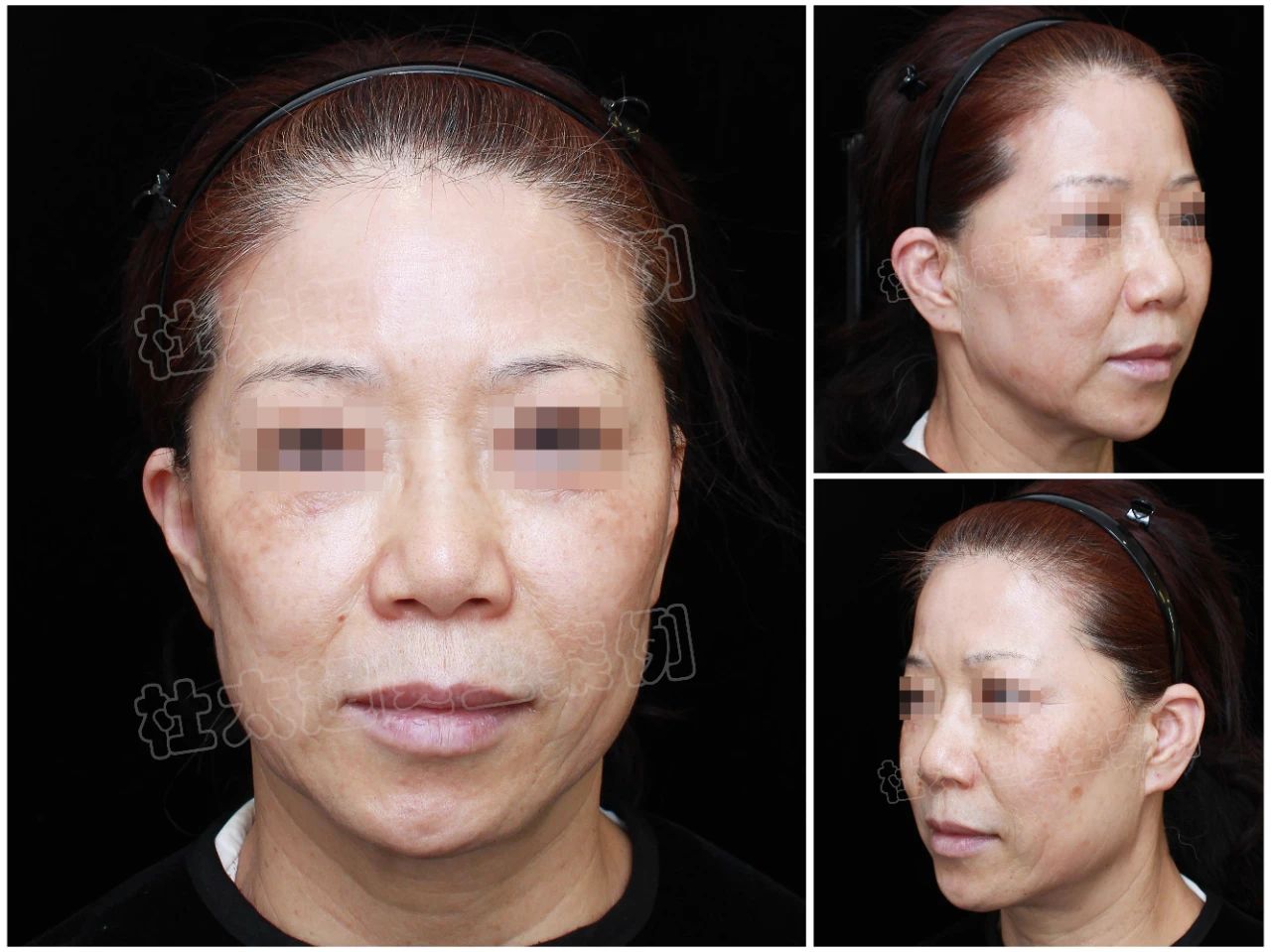 从巴黎到北京，这位55岁求美者如何跨越万里，实现caw小切口面部提升的逆龄奇迹？