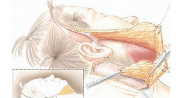 眼袋的钱花的太冤了，这次拉皮+眼袋修复，终于值了