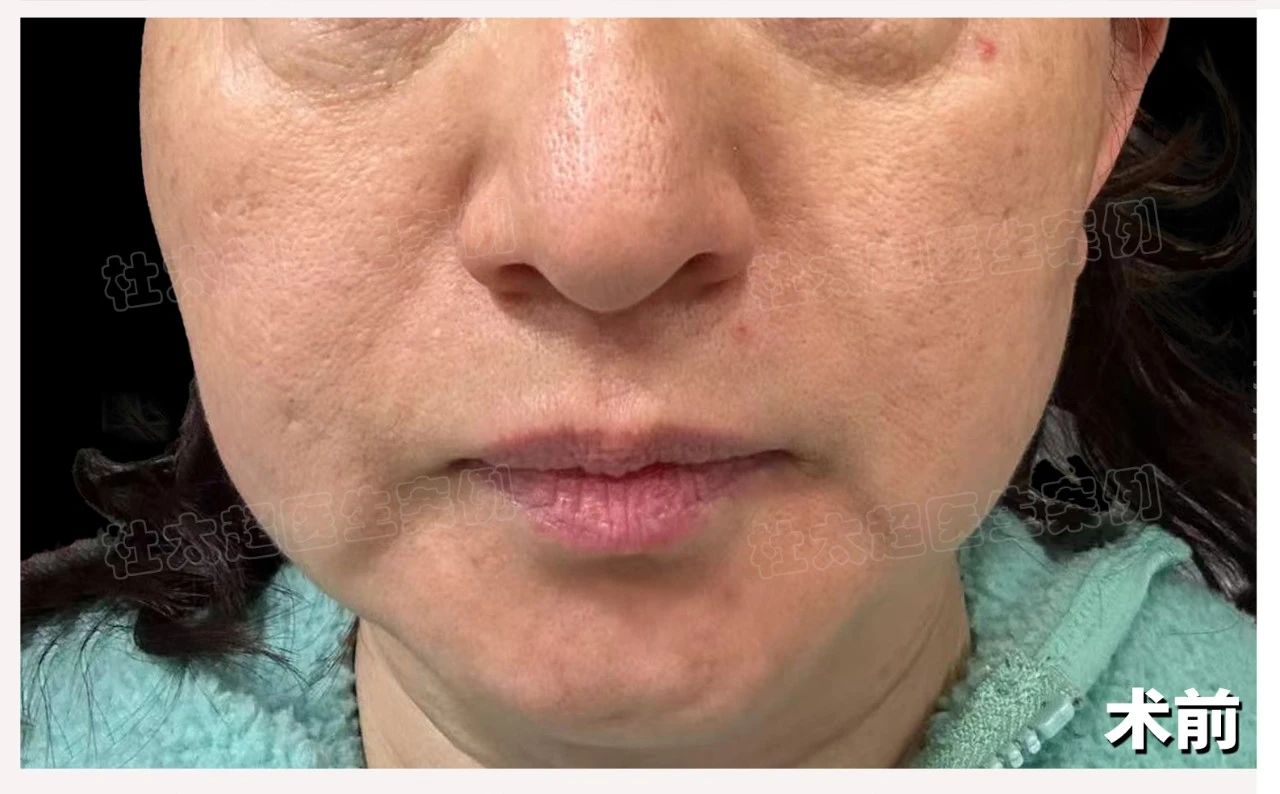 “美丽”国不能变美丽？53岁女士为什么选择回国接受拉皮手术？