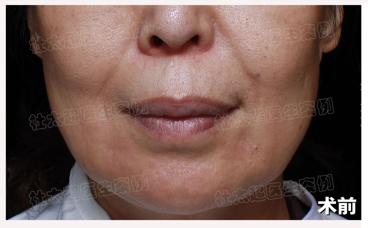 “医美真的能重生吗？看我如何从岁月痕迹中蜕变归来！"