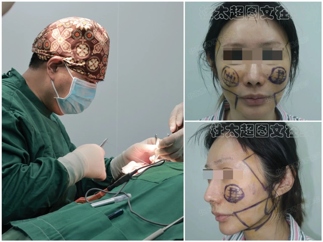 40岁勇敢尝试拉皮手术，术后18个月年轻蜕变：别小瞧了这个手术！