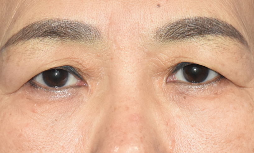 50岁眼皮松弛下垂最好的解决方法？