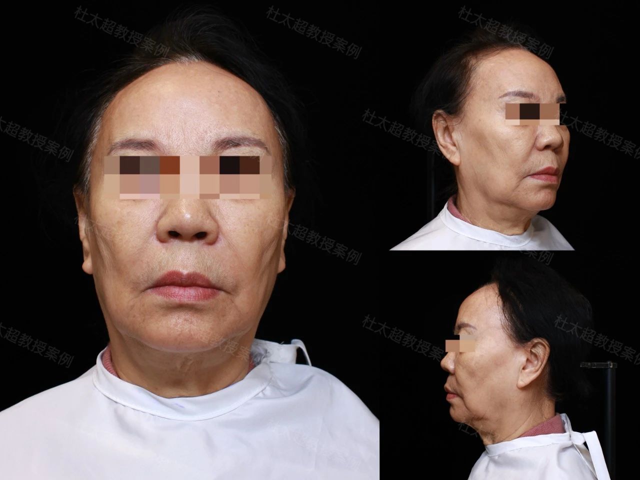 本命年能做拉皮手术吗?70岁奶奶告诉你,不惧任何因素,caw小切口面部提升缩紧术,术后6个月美出新高度! 本命年能做拉皮手术吗?70岁奶奶告诉你,不惧任何因素,caw小切口面部提升缩紧术,术后6个月美出新高度!