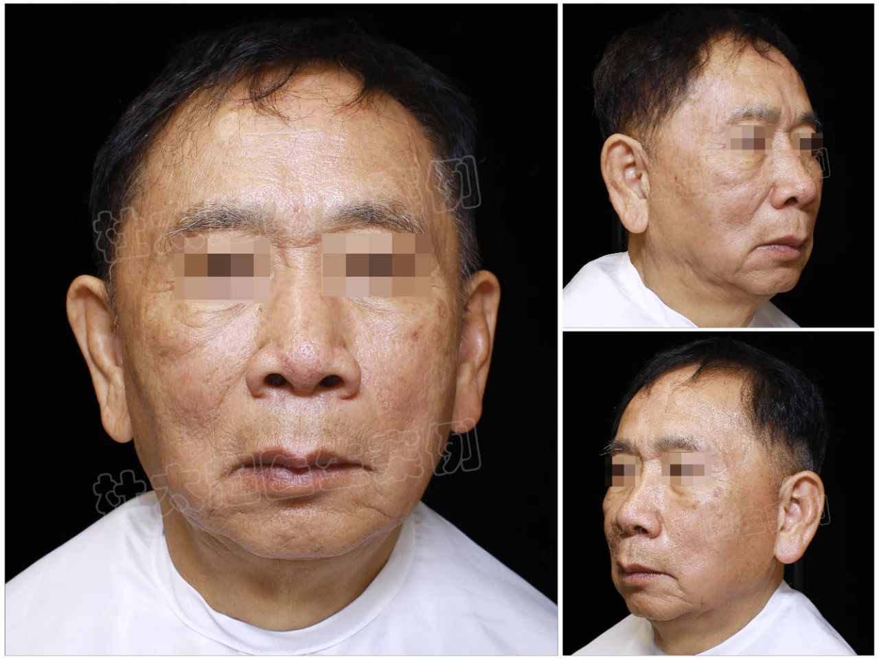 73岁绅士的逆龄之旅：拉皮手术术后6个月的华丽蜕变