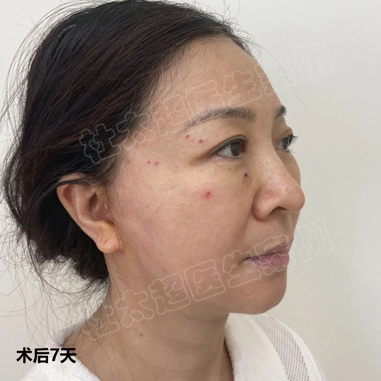 拉皮手术:caw小切口面部提升缩紧术四大特殊优势你知道吗? 拉皮手术:caw小切口面部提升缩紧术四大特殊优势你知道吗?